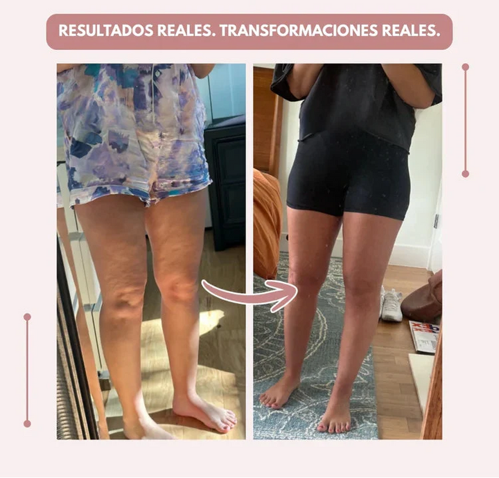 Curvella 3D Legging – Despídete del dolor y la fatiga del lipoedema de forma natural