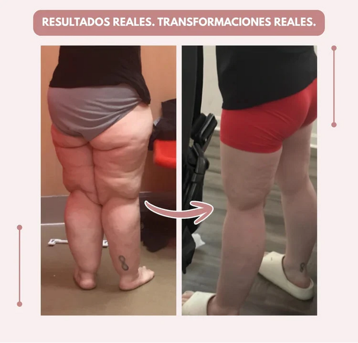 Curvella 3D Legging – Despídete del dolor y la fatiga del lipoedema de forma natural