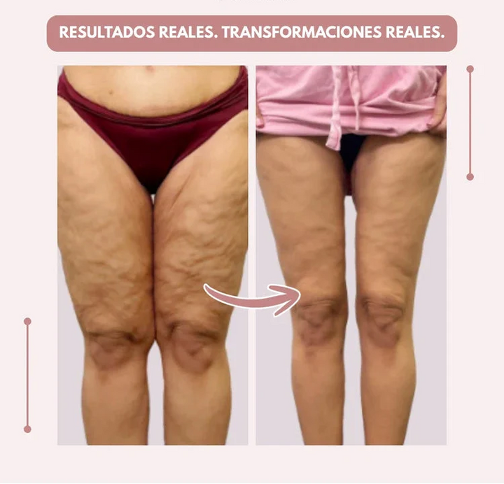 Curvella 3D Legging – Despídete del dolor y la fatiga del lipoedema de forma natural