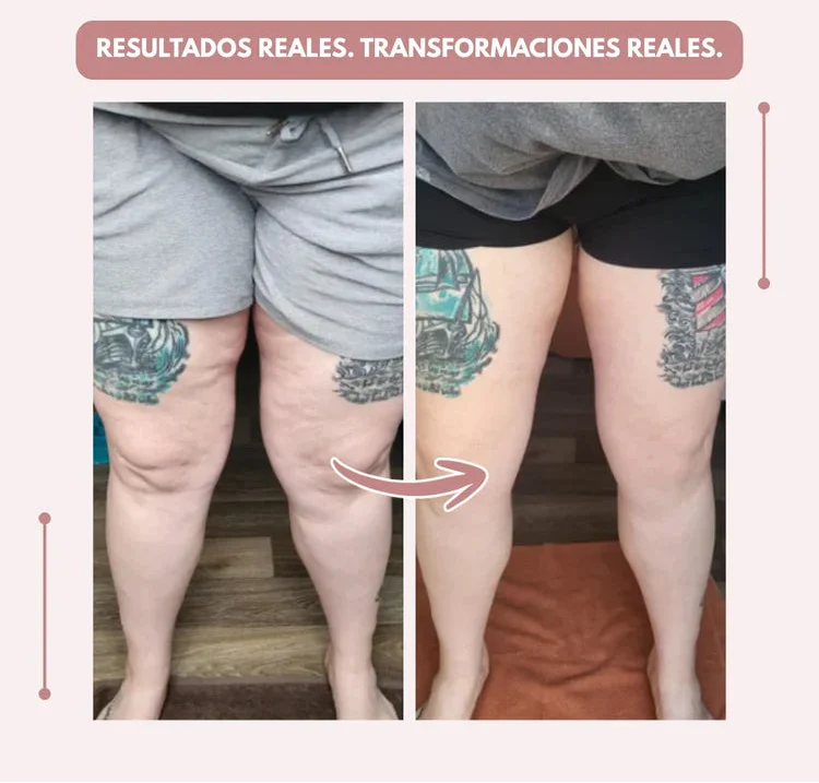 Curvella 3D Legging – Despídete del dolor y la fatiga del lipoedema de forma natural